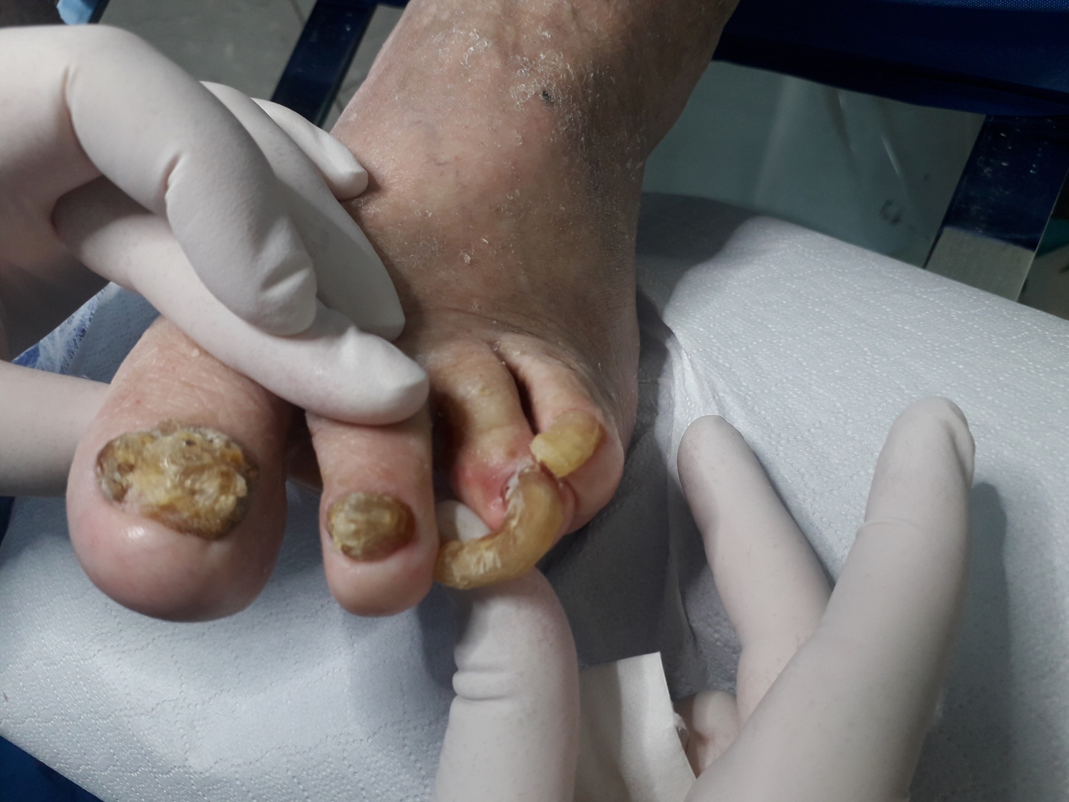cum să tratezi ciuperca unghiilor de la picioare remedii populare cauzele ciupercilor pe unghiile mâinilor și picioarelor
