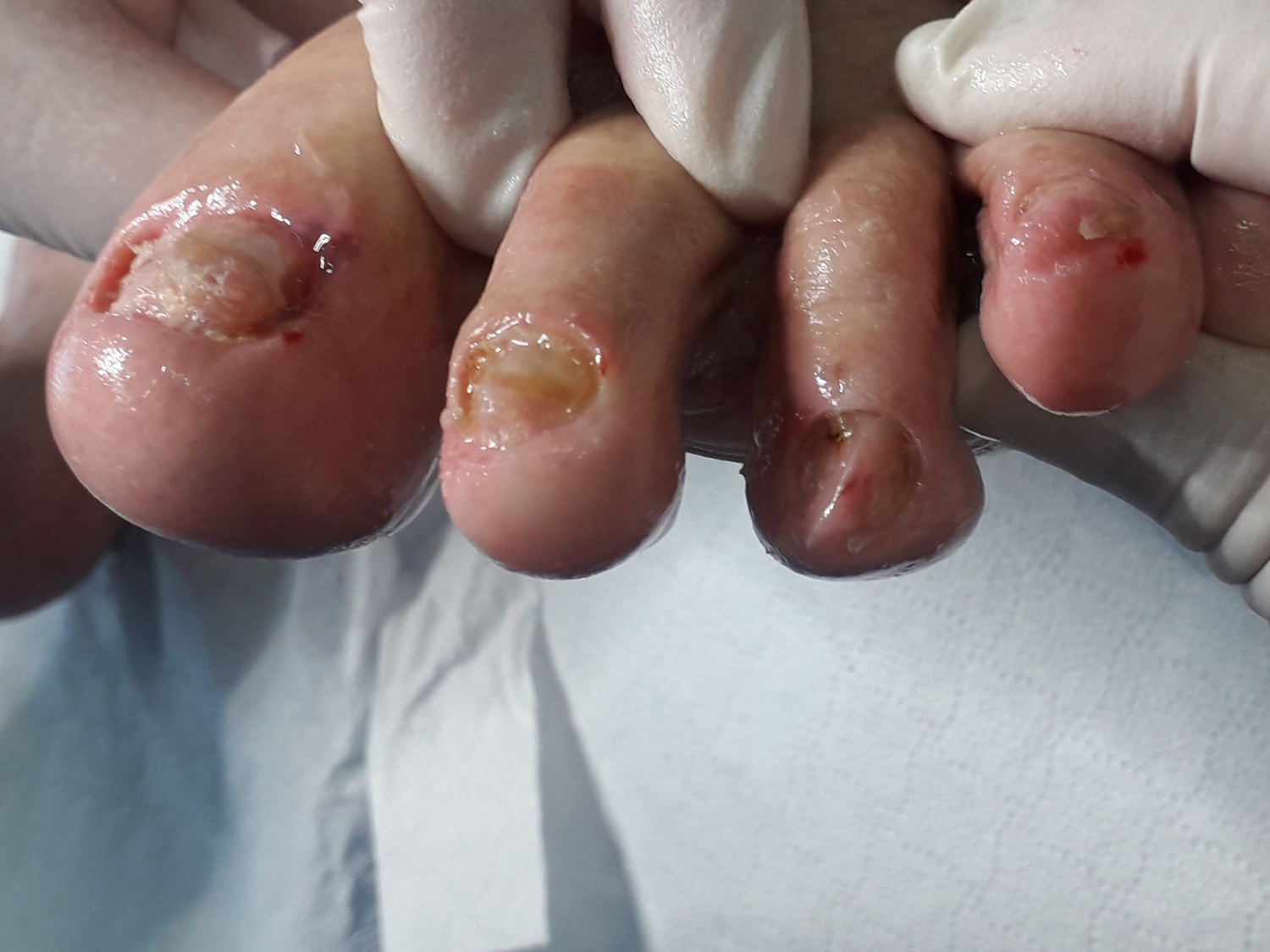 unghia se desprinde dar nu ciuperca poți vindeca ciuperca unghiilor de la picioare cu lămâie