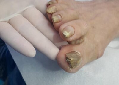 complex de ciuperci ale unghiilor de la picioare)